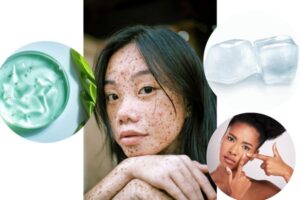 how to get rid of pimples overnight