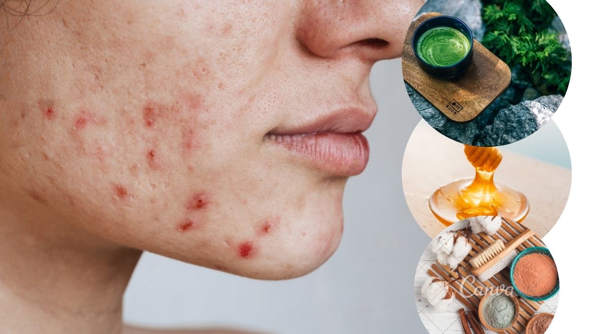 how to get rid of pimples Overnight